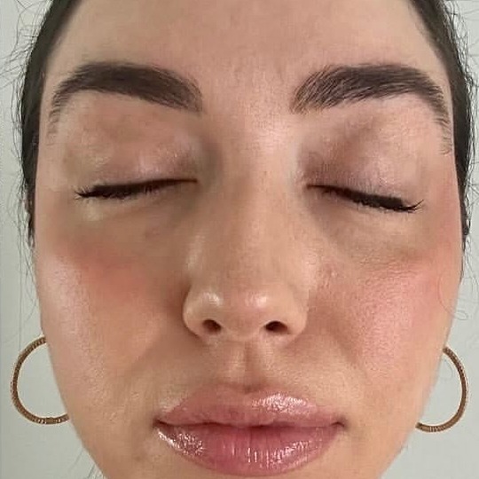 After: BBL HEROic (décolleté)