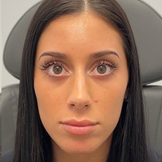 After: Botox & Wrinkle Correction