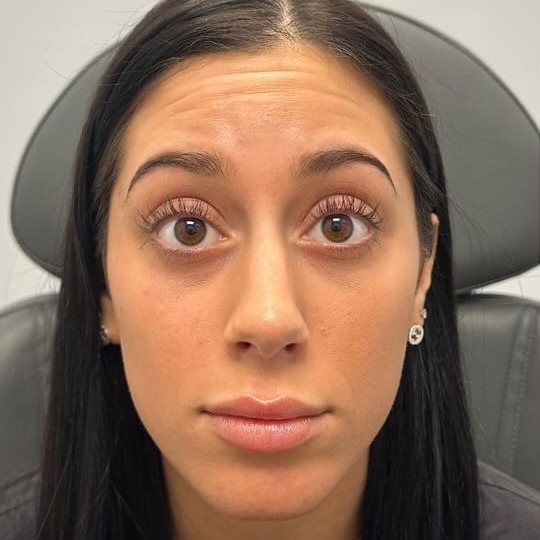 Before: Botox & Wrinkle Correction