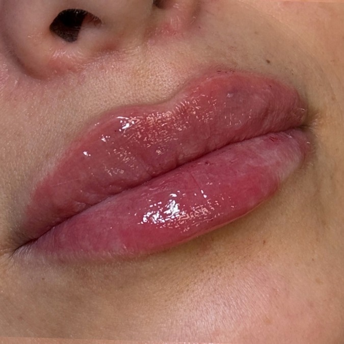 After: Dermal Fillers & Lip Contouring