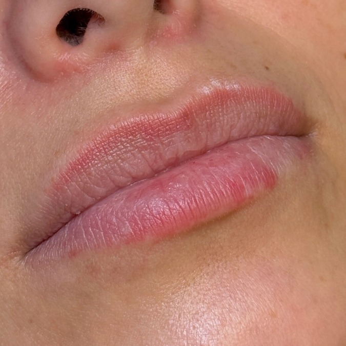 Before: Dermal Fillers & Lip Contouring